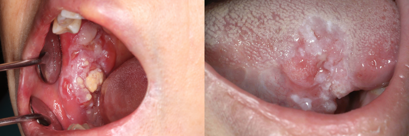 Patients with oral cancer